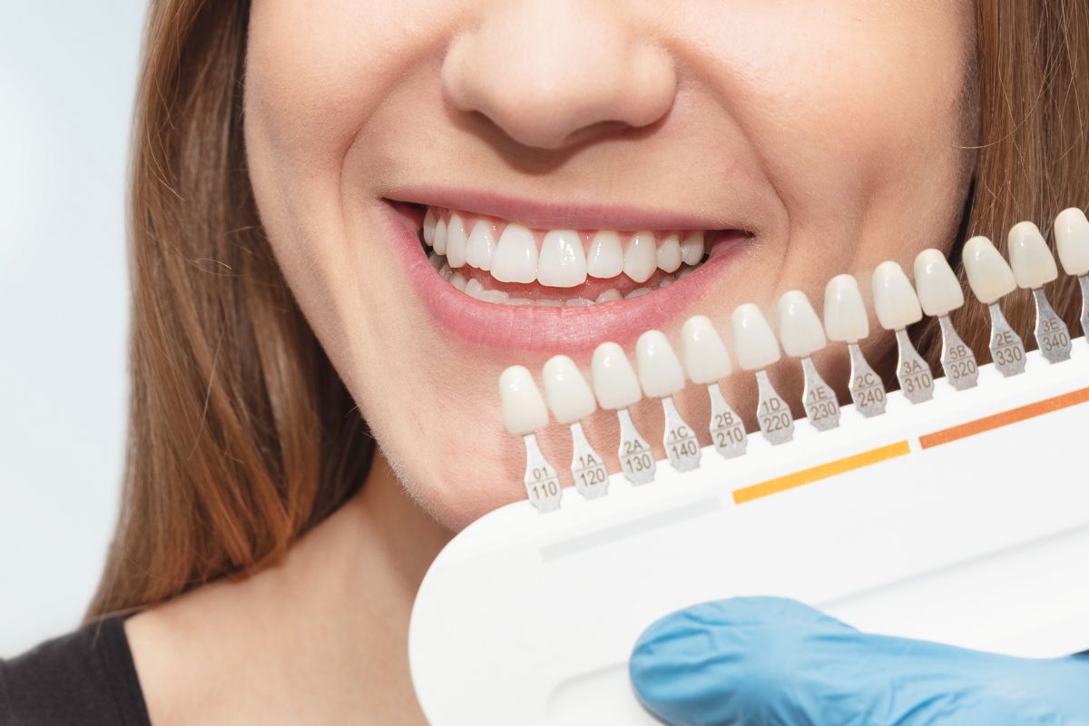Professional Dental Bleaching