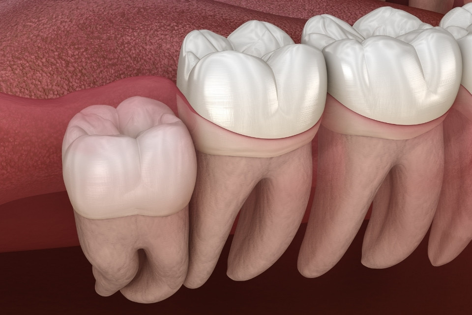 Wisdom Tooth Removal in Surrey Treatments and Cost
