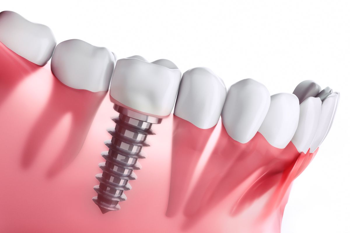 what are dental implants