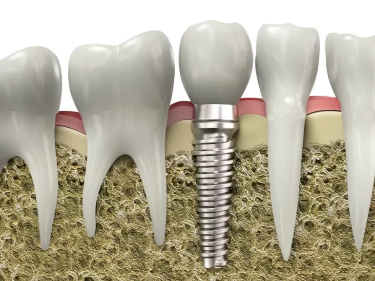 Dental Implants and Osteoporosis