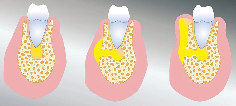 tooth-abscess