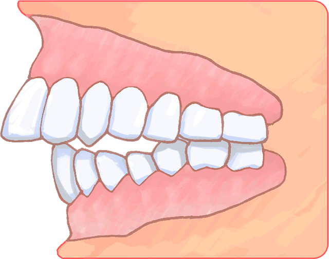 class2 malocclusion surrey