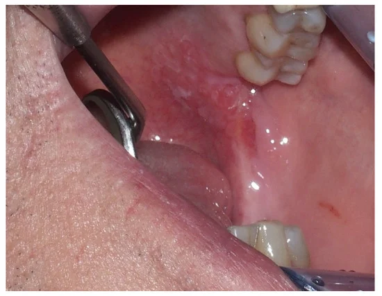 oral cancer detection surrey