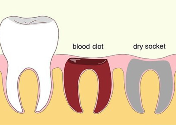 dry socket