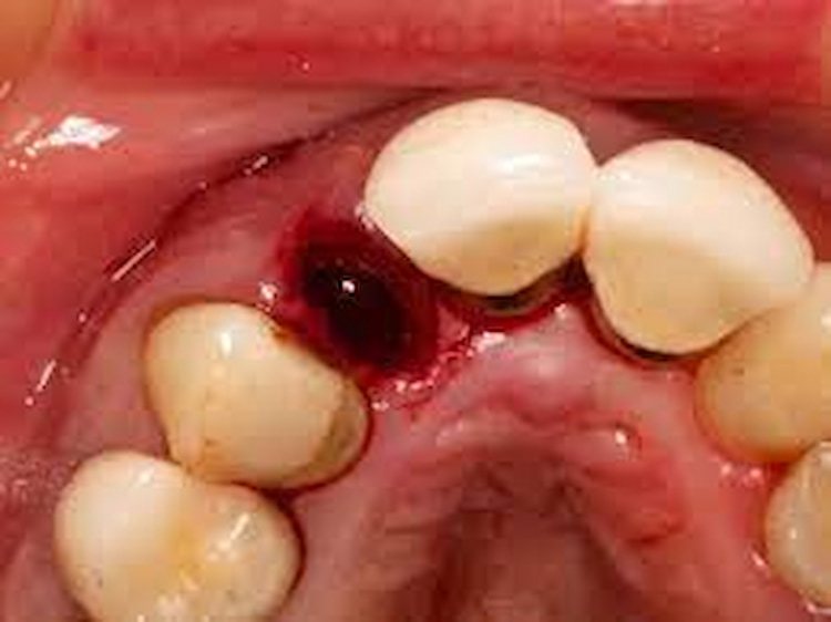 Treatment Options for Dry Socket