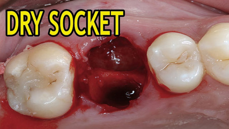 What Is Dry Socket?