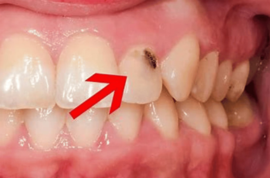 What is a Cavity on Front Tooth