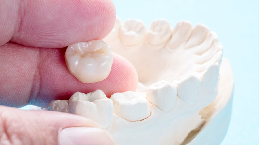 Types of Dental Crowns