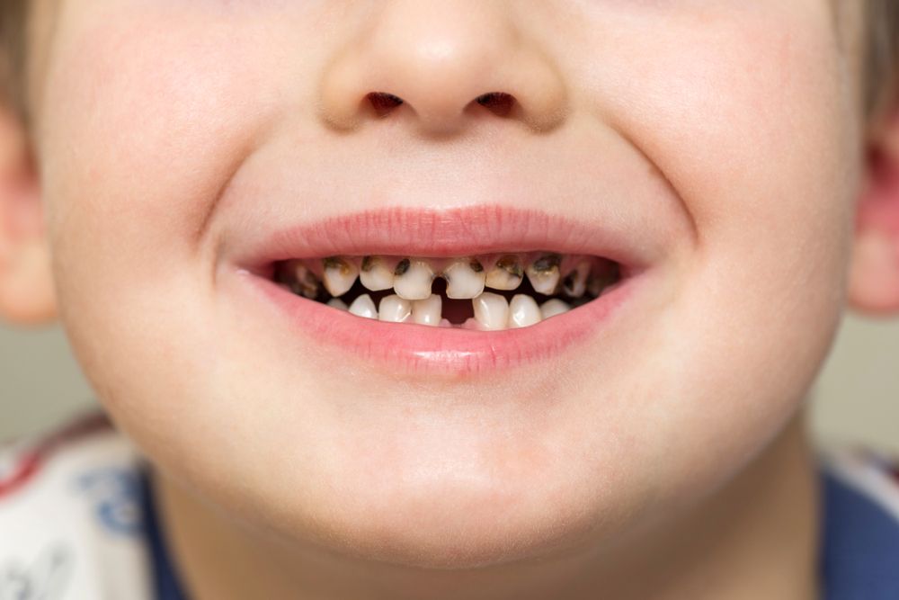 cavity on front teeth