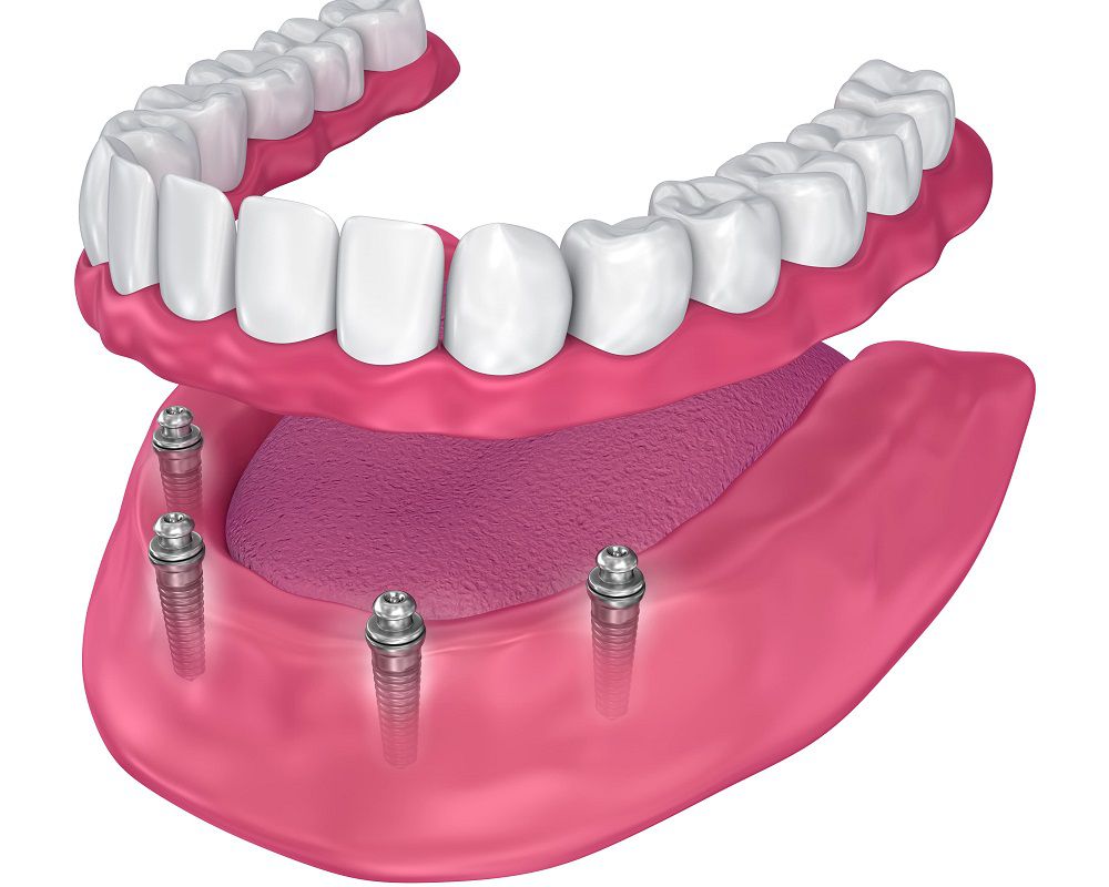The Denture Process in Surrey at Smile Plus