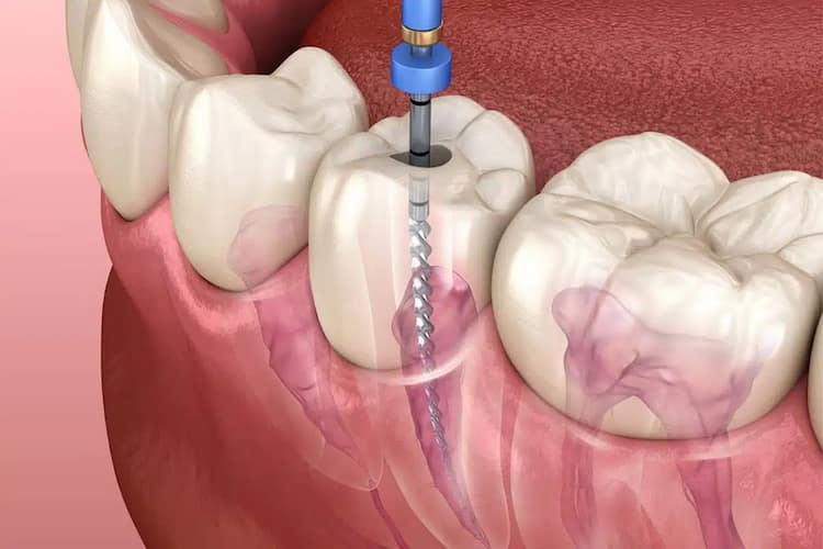 Root Canal