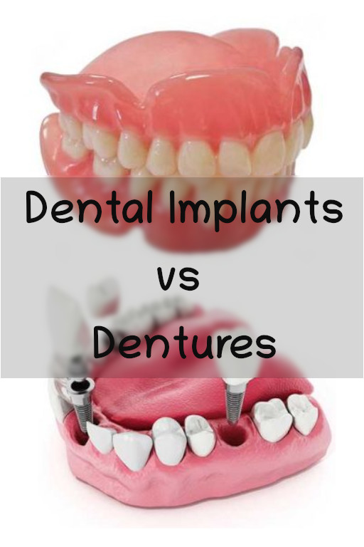 dental implants vs dentures