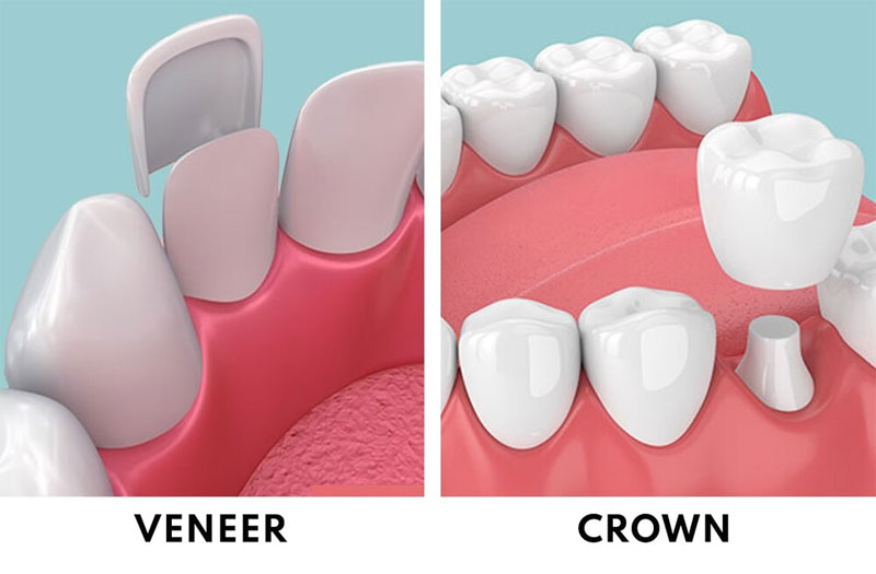 veeners vs crowns