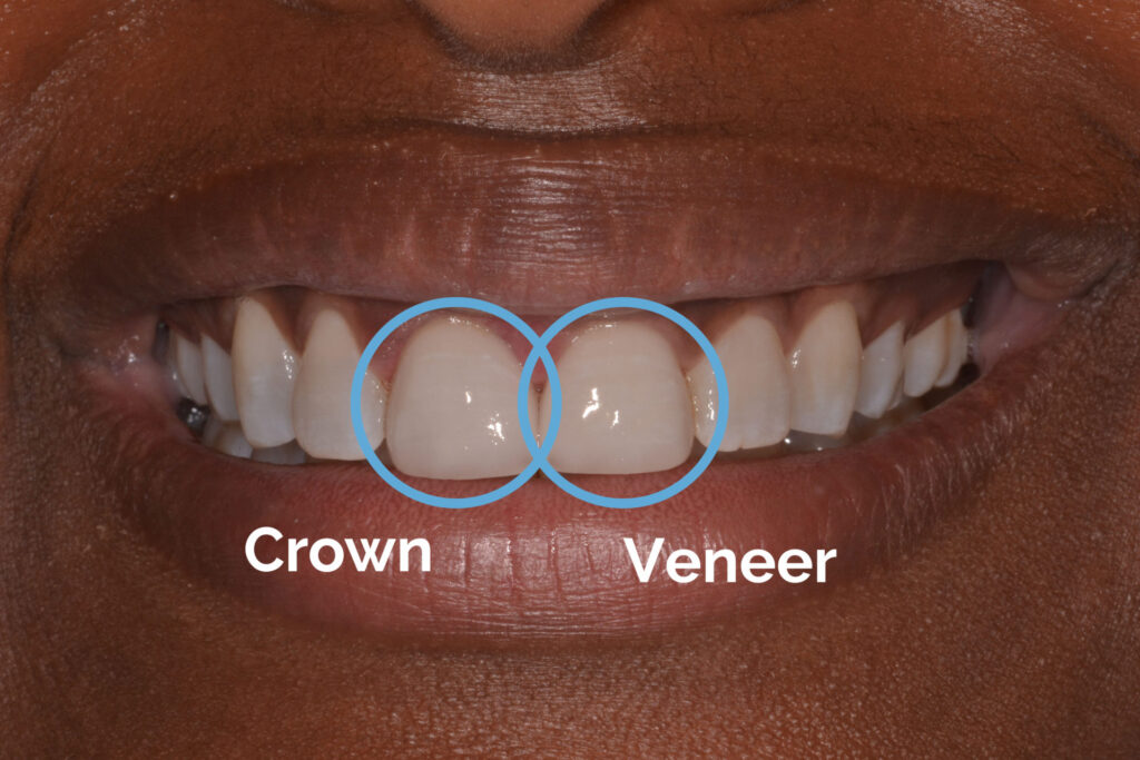 Veneers Vs. Crowns: Understanding the Differences, Benefits, and Choosing the Right Option for Your Smile