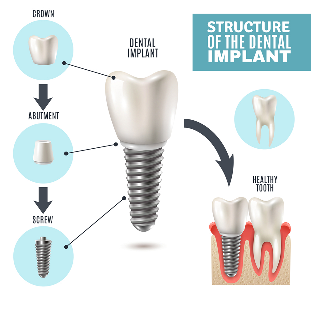 The Process of Getting Dental Implants