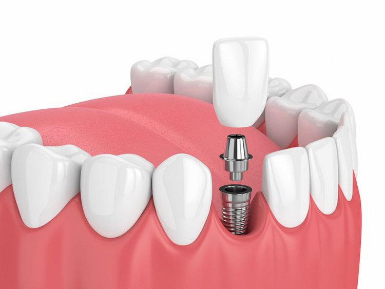 Implant Placement Surgery
