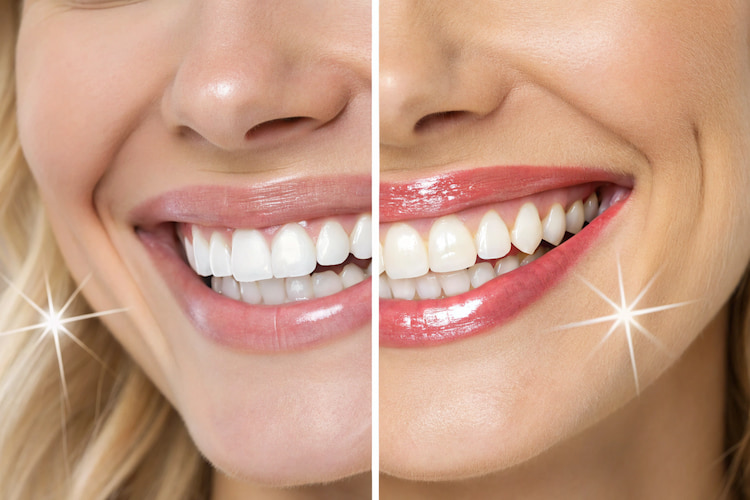 professional whitening