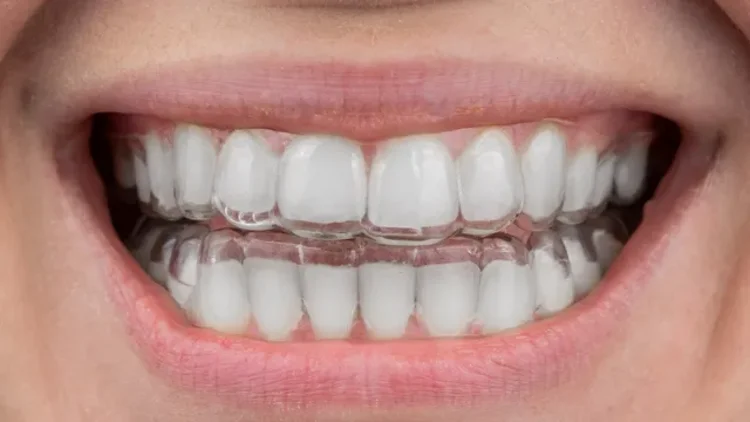 A picture of clear aligners