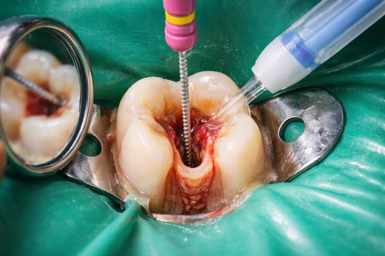 A picture taken in the middle of root canal procedure