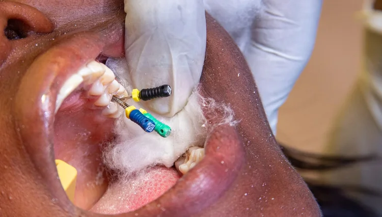 A picture of a patient in the middle of the root canal treatment process