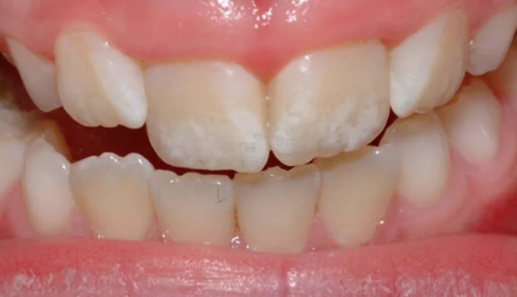 A picture showcasing white spots on teeth