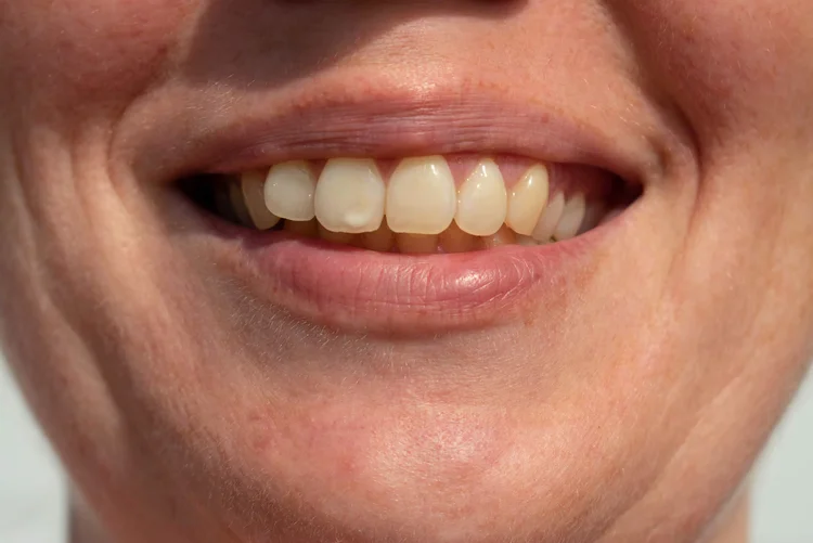 A picture of a woman with white spots on her teeth
