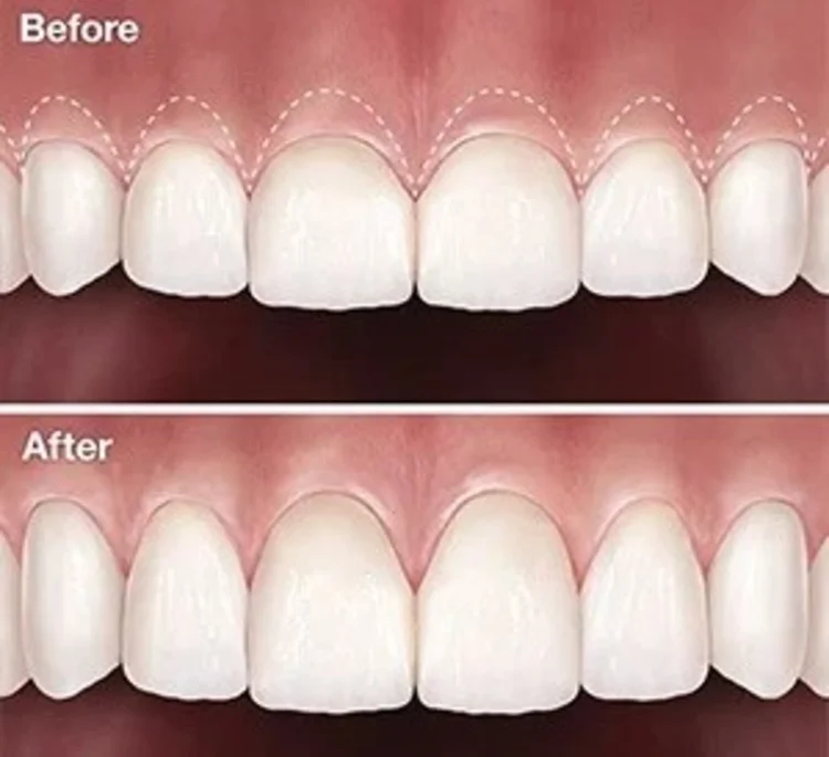 A before and after picture of dental crown procedure