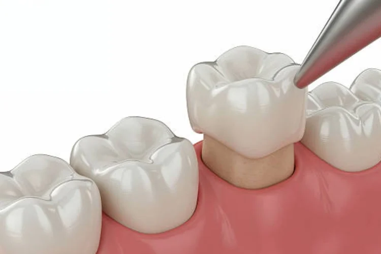 A picture representing crown lengthening
