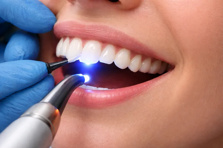 A picture representing dental bonding