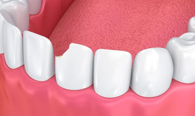 An image of a cracked (chipped) tooth