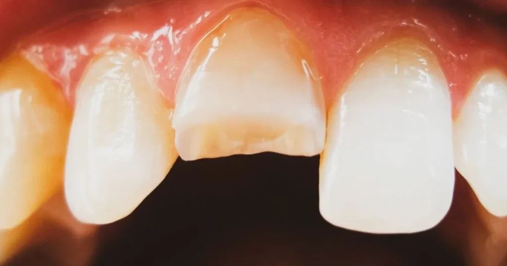 A picture of a chipped tooth