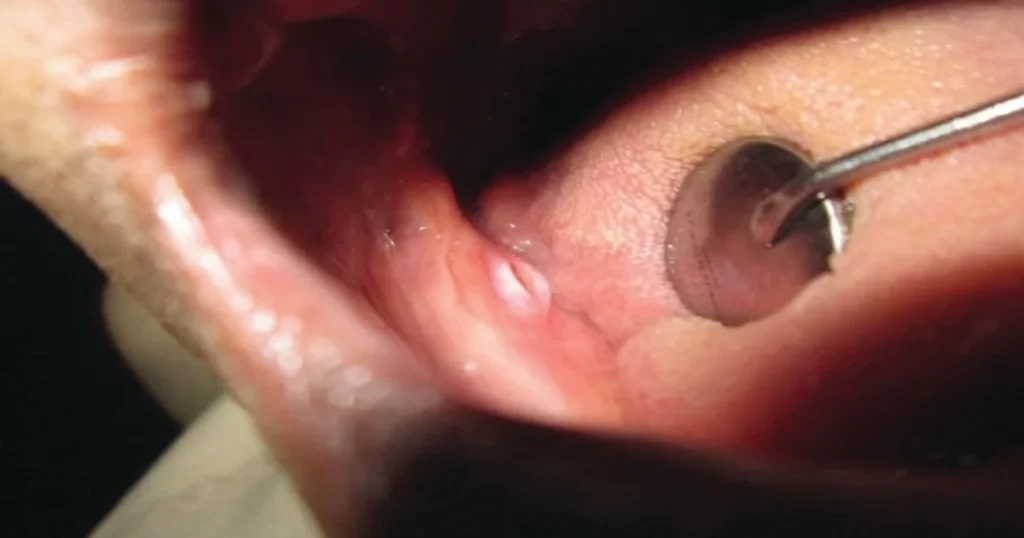 A picture of a denture sore