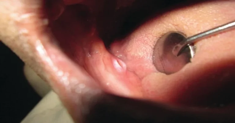 A picture of a denture sore