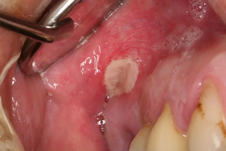 A picture representing denture sores