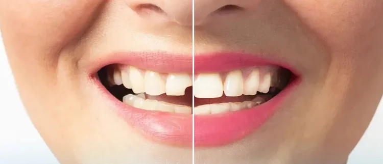A before and after picture of dental bonding