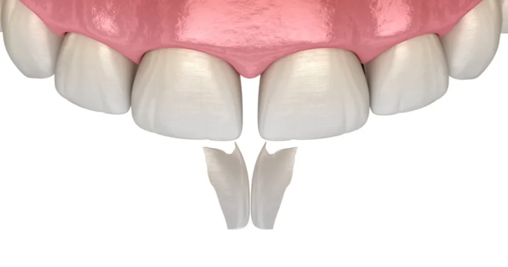 A picture representing dental bonding