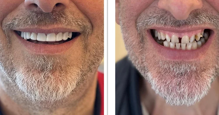 A picture of a man after dental bonding