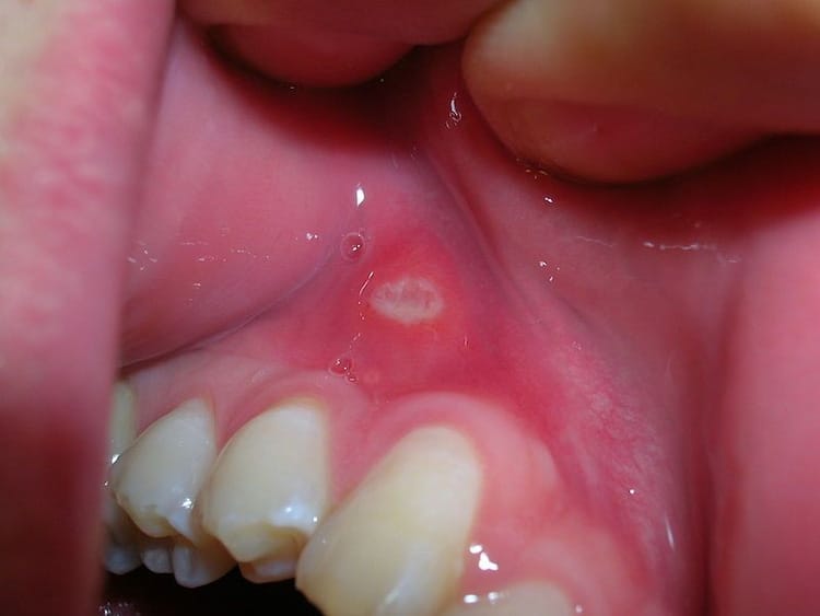 pictures of denture sores