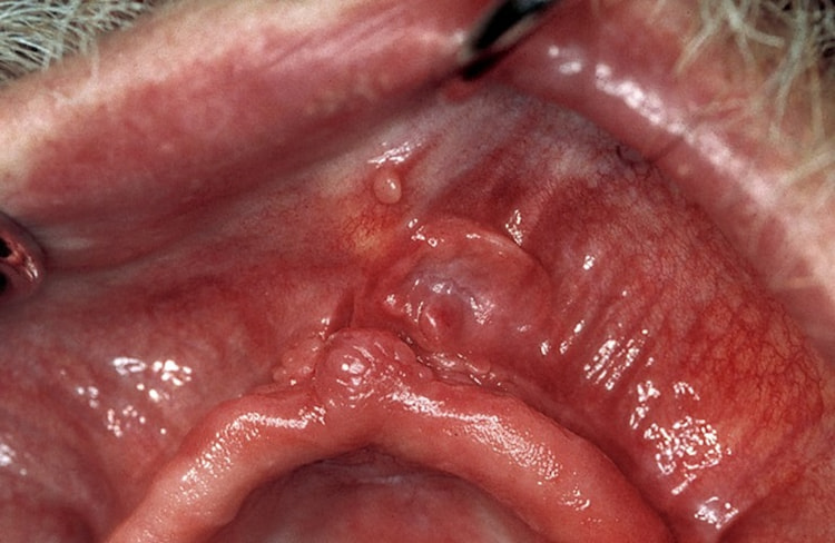 picture of denture sores