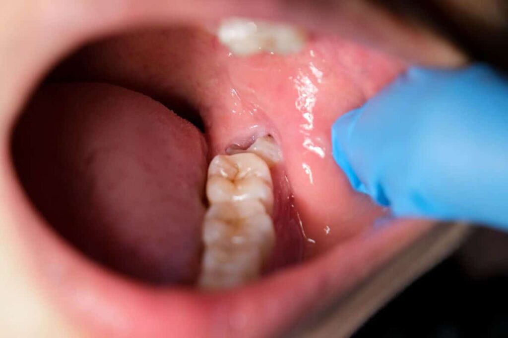 everything you need to know about wisdom teeth removal in Toronto