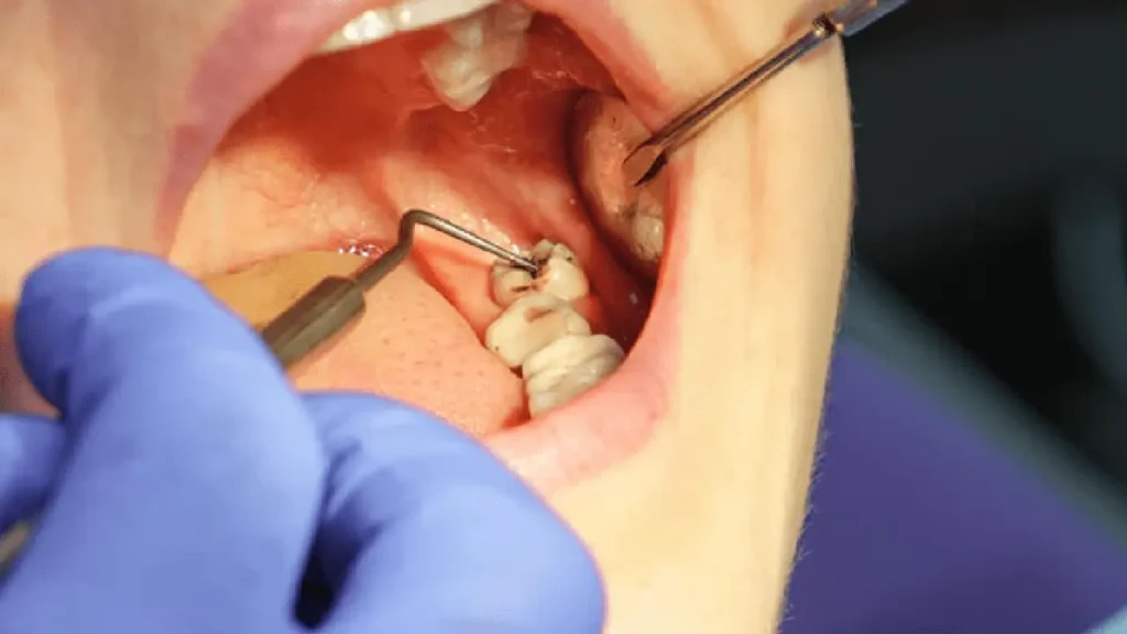 wisdom teeth removal in Surrey
