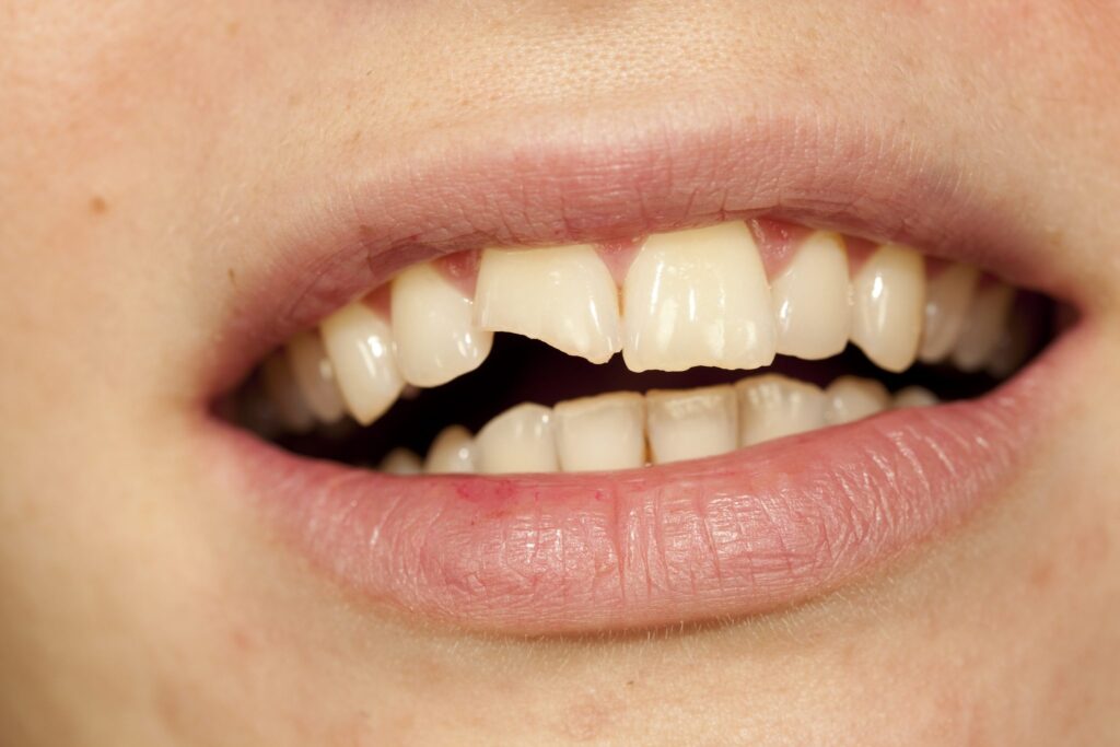 a chipped tooth as a dental emergency