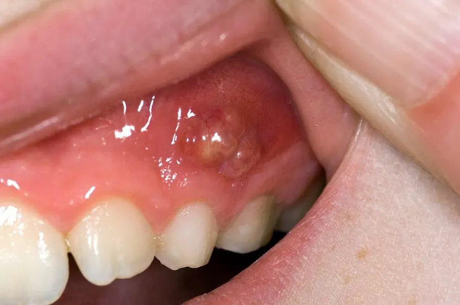 a dental abscess as a dental emergency