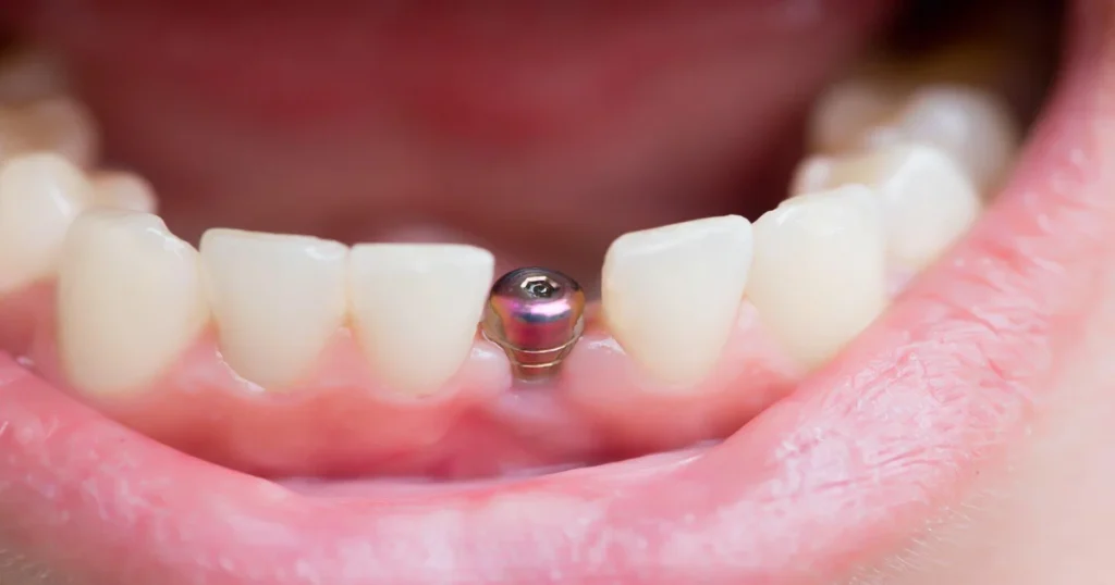 A picture of an unfinished dental implant