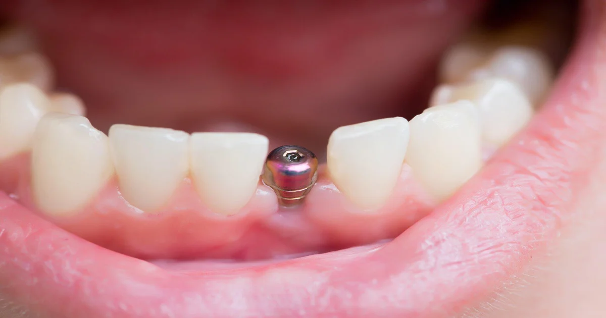 A picture of an unfinished dental implant