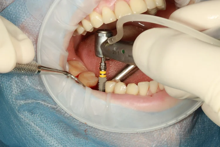 A picture showing how dental implants are done