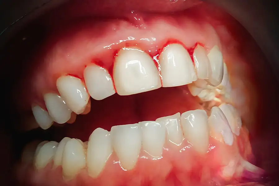 skipping teeth cleaning consequences: Periodontitis