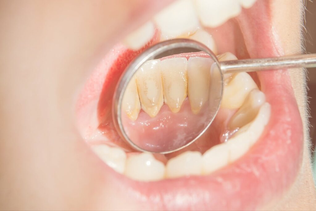 skipping teeth cleaning consequences: plaque and tartar buildup
