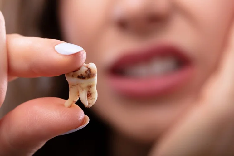 A picture of a knocked out tooth