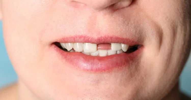 A picture of a knocked out front teeth